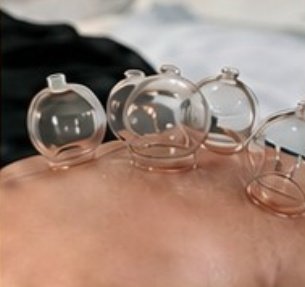 Cupping Therapy (Hijama) view 1